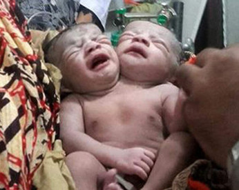 Mulher dá à luz gêmeas com duas cabeças em um único corpo, em Bangladesh