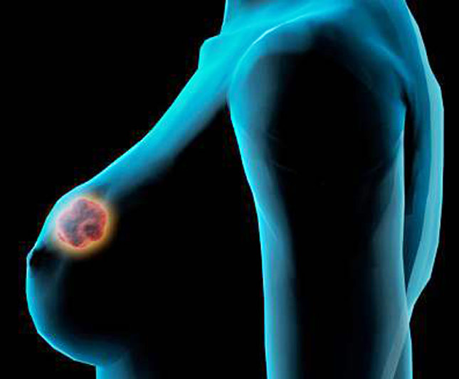 Nova forma de quimioterapia estacionaria câncer de mama por 24 anos