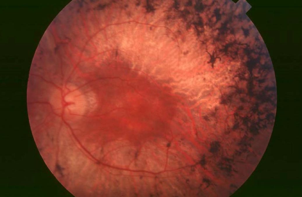 Cientistas criam técnica capaz de reverter cegueira causada por doença na retina