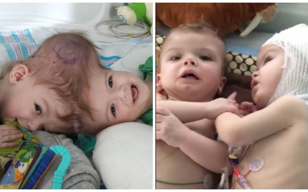 Bebês que nasceram unidos pela cabeça interagem lado a lado pela primeira vez