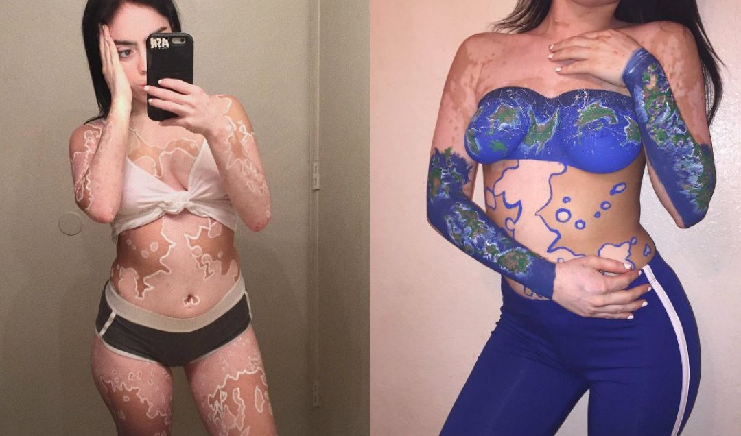 Garota com vitiligo supera bullying transformando corpo em arte