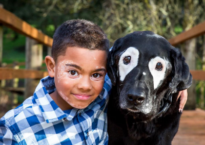 Vitiligo une garoto e cachorro com mesma condição