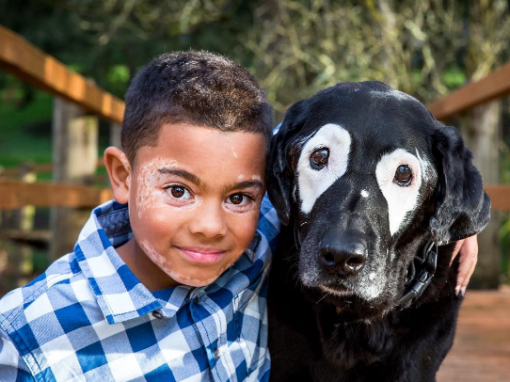 Vitiligo une garoto e cachorro com mesma condição