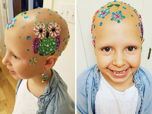 Garota diagnosticada com alopecia ganha auto-estima com “cabelos” diferentes