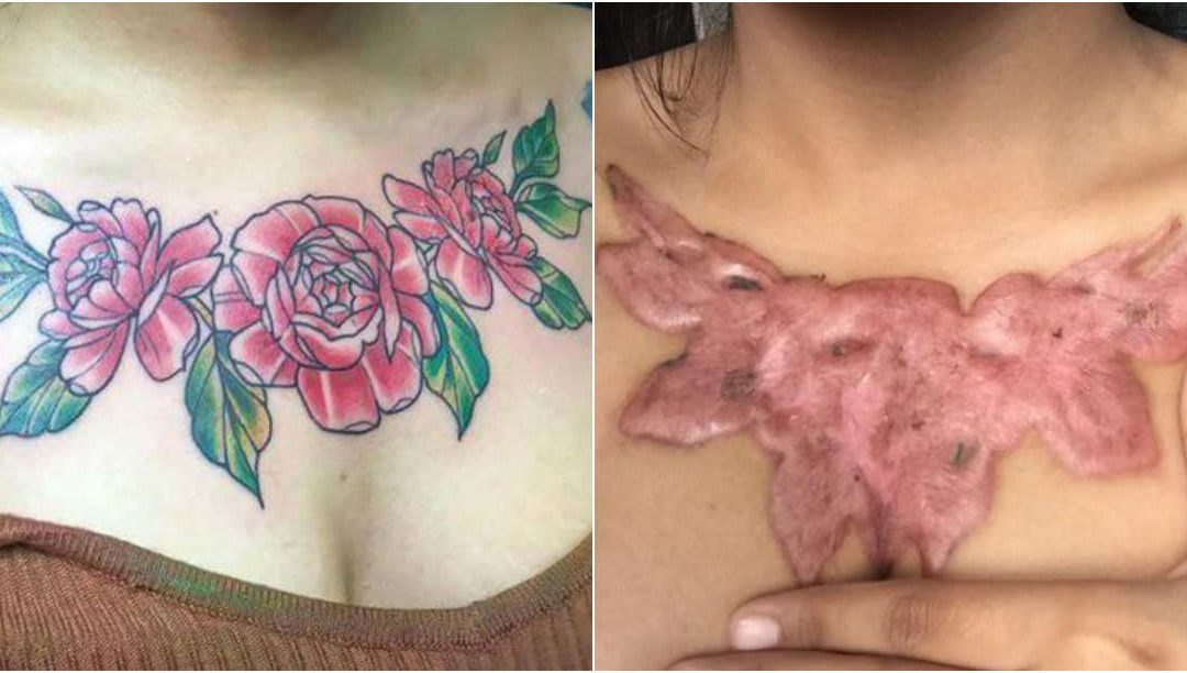 Tratamento alternativo para remoção de tatuagem deixa jovem com enorme cicatriz