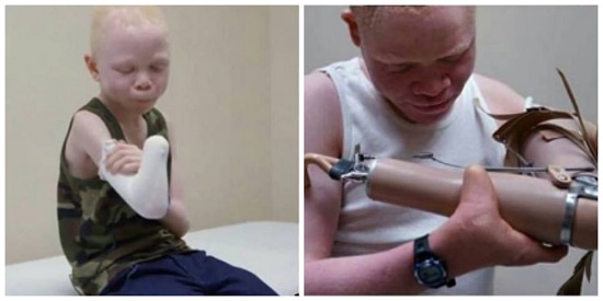 Crianças albinas que perderam membros em ritual de magia ganham próteses