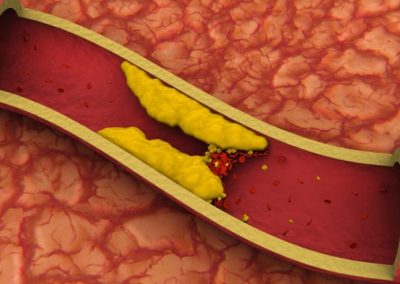 Cientistas testam vacina contra colesterol