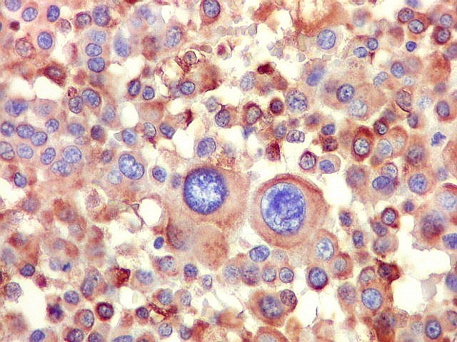 Cientistas identificam proteína central de câncer