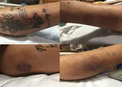 Homem morre por contrair bactéria no mar através de tatuagem recente