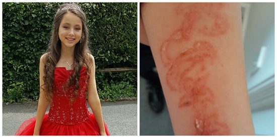 Após reação, tatuagem de henna pode deixar pele de garota marcada para sempre