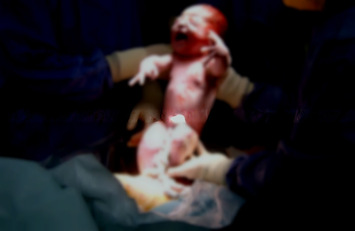 Médica grávida sofre aborto espontâneo enquanto fazia cesárea em paciente