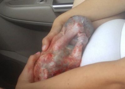 Ainda em carro, bebê nasce dentro de bolsa amniótica