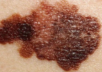Cientistas afirmam poder deter avanço do melanoma