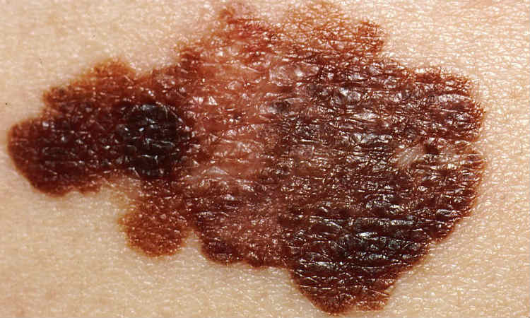 Cientistas afirmam poder deter avanço do melanoma
