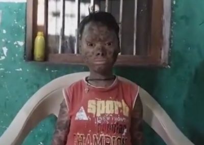 Garota troca de pele a cada 45 dias e aposta que cirurgia mudará sua vida