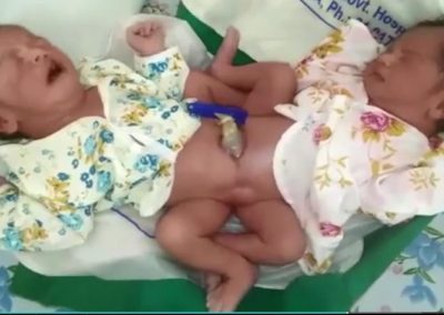 Em caso raro, bebês siameses nascem de parto normal