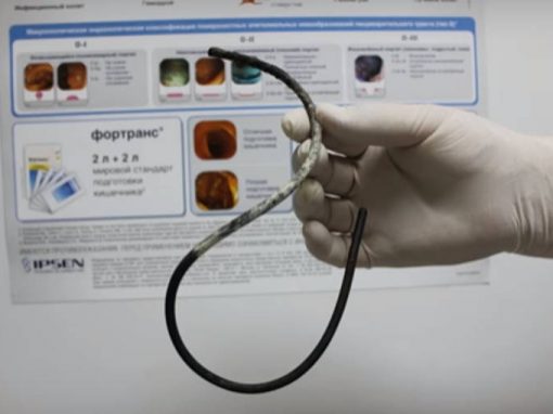 Médicos retiram tubo de 30 cm de estômago de mulher 17 anos depois