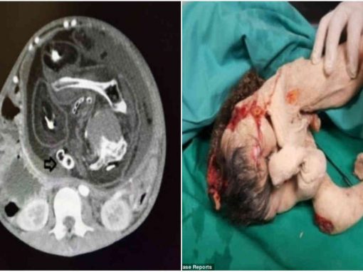 Médicos retiram “feto de irmão gêmeo” do estômago de garoto de 15 anos