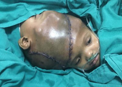 Irmãos siameses sobrevivem a separação de cérebro em cirurgia de 36h