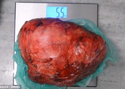 Equipe remove maior tumor renal do mundo, com 5,5kg