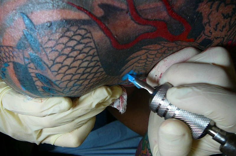 Médicos descobrem que “câncer” de mulher era reação à tatuagem