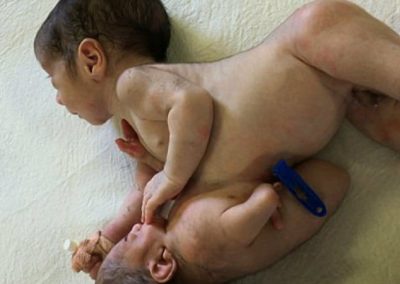 Médicos removem “gêmeo parasita” de estômago de bebê