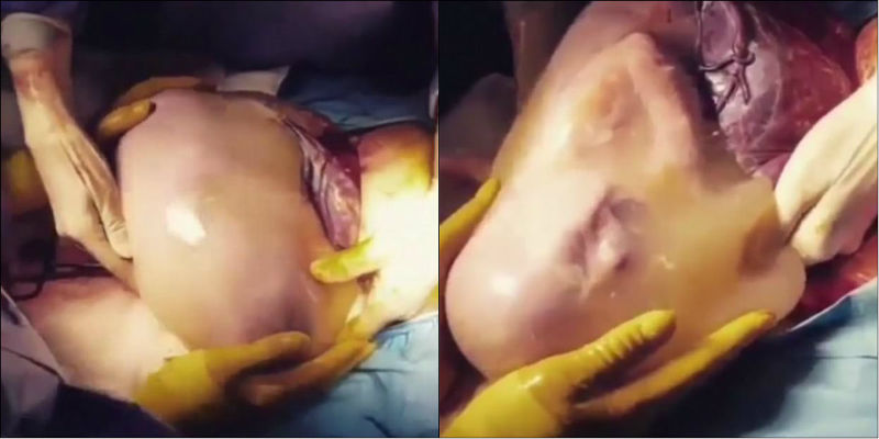 Médicos filmam parto raro de bebê em saco amniótico fora do útero