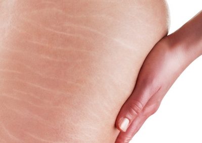 Técnica brasileira de tatuagem esconde estrias e até olheiras