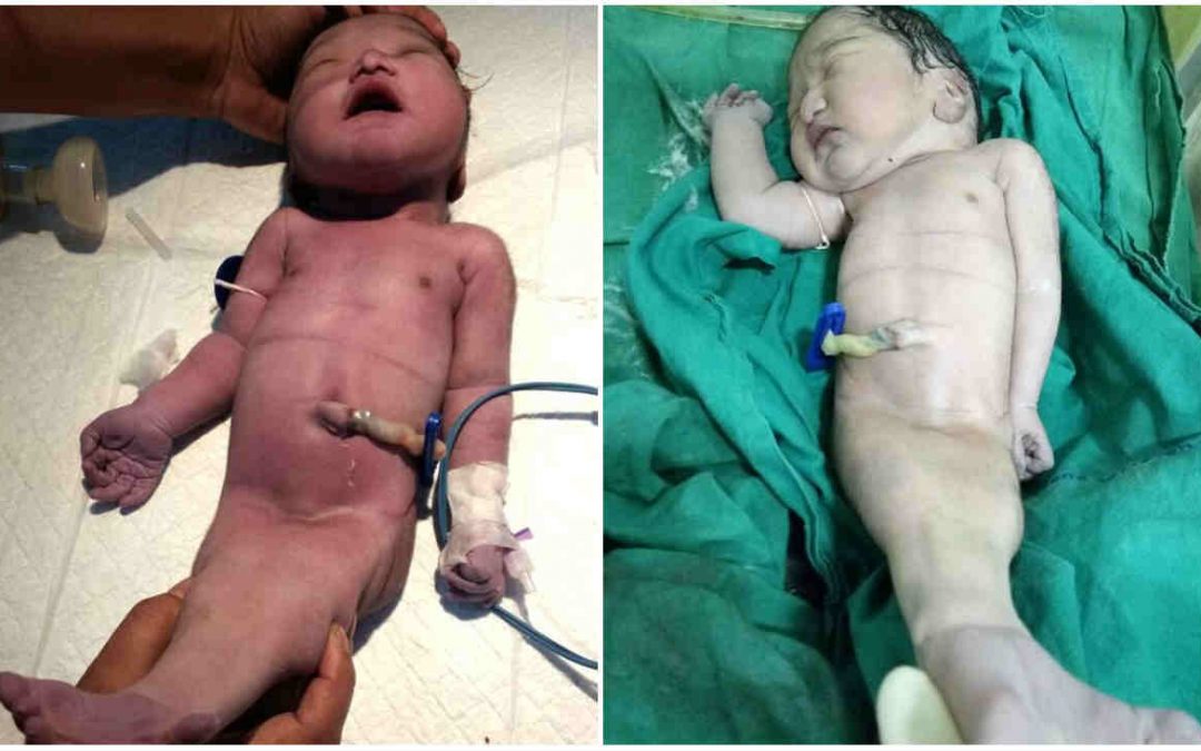 Bebê nasce com síndrome da sereia e imagem repercute no mundo