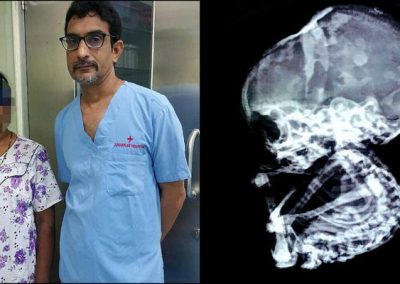 Médicos retiram feto de estômago de mulher que achava tê-lo abortado há 15 anos