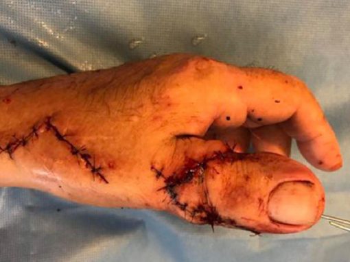 Para poder andar de moto, homem tem dedo do pé implantado em mão amputada