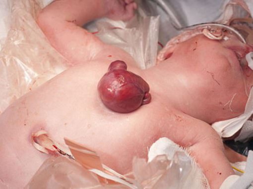 Bebê nasce com coração fora do corpo e mobiliza equipe médica por cirurgia