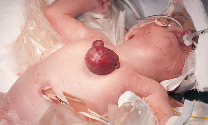 Bebê nasce com coração fora do corpo e mobiliza equipe médica por cirurgia