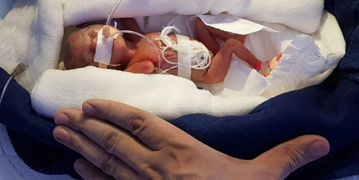 Bebê nasce com 400g e é salva pelos médicos