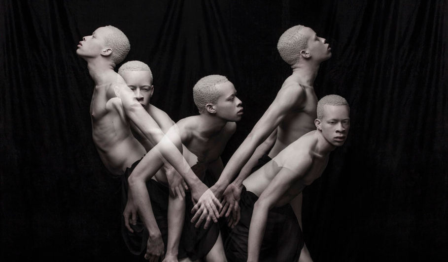 Contra preconceito, fotógrafo lança ensaio com albinos