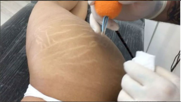 Brasileiro desenvolve técnica que faz estrias “desaparecerem” com tatuagem
