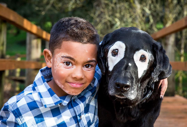 Vitiligo une garoto e cachorro com mesma condição