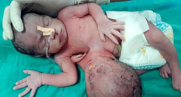 Bebê indiana nasce com segunda cabeça ligada ao estômago