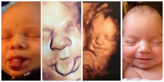 Obstetra faz sucesso ao comparar ultrassom 3D e fotos de bebês após nascimento