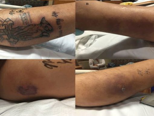 Homem morre por contrair bactéria no mar através de tatuagem recente