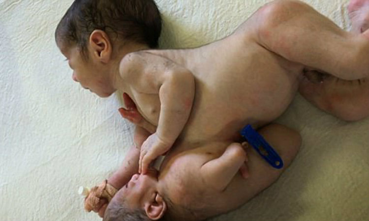 Médicos removem “gêmeo parasita” de estômago de bebê