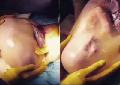 Médicos filmam parto raro de bebê em saco amniótico fora do útero