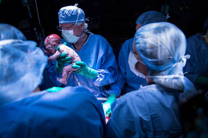 Nasce 1º bebê da América gerado em útero transplantado
