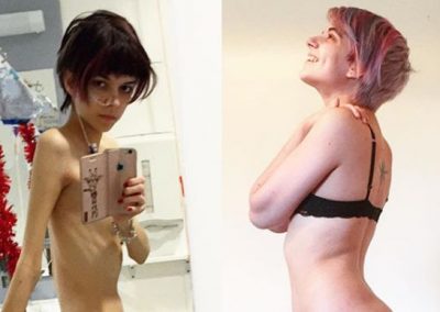 Estudante vence anorexia e usa redes sociais para “salvar” adolescentes