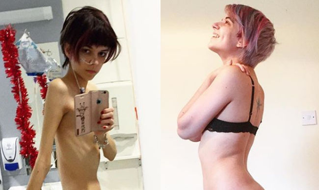 Estudante vence anorexia e usa redes sociais para “salvar” adolescentes